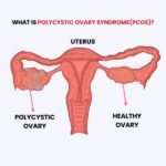 labeled-anatomical-diagram-comparing-a-polycystic-ovary-to-a-healthy-ovary