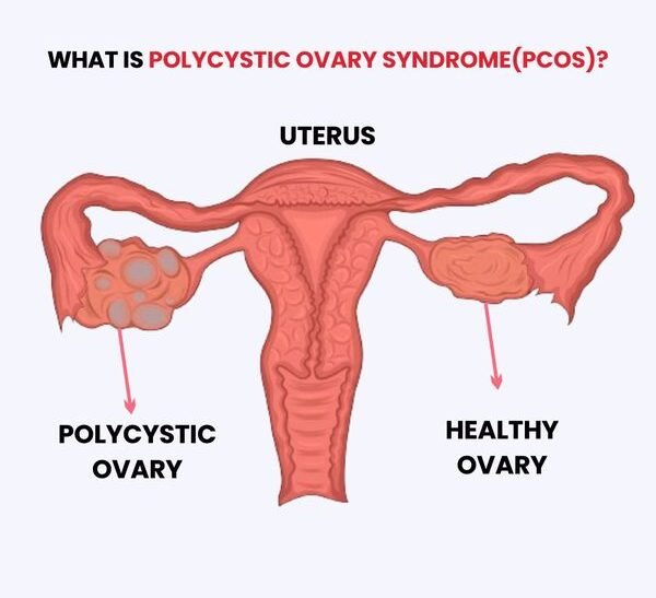 labeled-anatomical-diagram-comparing-a-polycystic-ovary-to-a-healthy-ovary